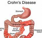 Crohn’s Disease